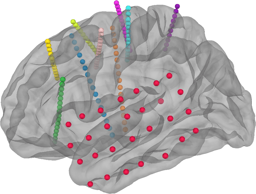 Semi-transparent 3D render of a human brain with depth-electrode contacts shown as colored bead strings threading into the tissue and red surface-electrode spheres across the cortex.